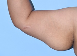 Arm Lift (Brachioplasty)