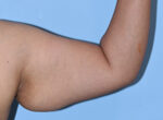 Arm Lift (Brachioplasty)