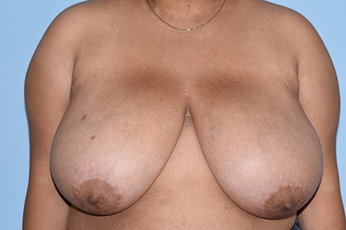 Breast Reduction ( Reduction Mammoplasty)