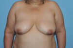 Breast Reduction (Reduction Mammoplasty)