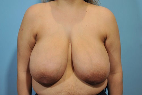 Breast Reduction ( Reduction Mammoplasty)