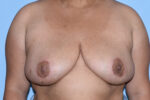 Breast Reduction ( Reduction Mammoplasty)