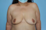 Breast Reduction ( Reduction Mammoplasty)