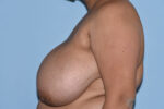 Breast Reduction ( Reduction Mammoplasty)