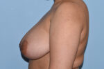 Breast Reduction ( Reduction Mammoplasty)