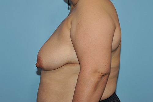 Breast Reduction (Reduction Mammoplasty)