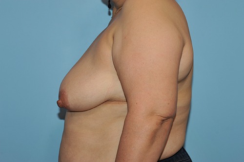 Breast Reduction ( Reduction Mammoplasty)