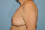 Breast Reduction ( Reduction Mammoplasty)