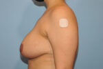 Breast Reduction ( Reduction Mammoplasty)