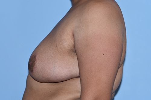 Breast Reduction ( Reduction Mammoplasty)