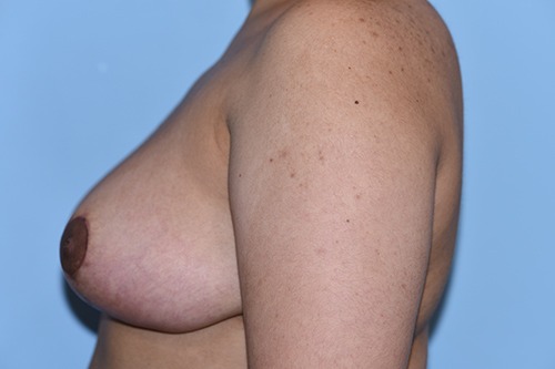 Breast Reduction ( Reduction Mammoplasty)