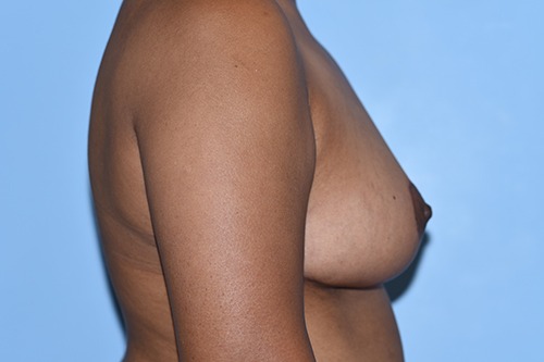 Breast Reduction (Reduction Mammoplasty)