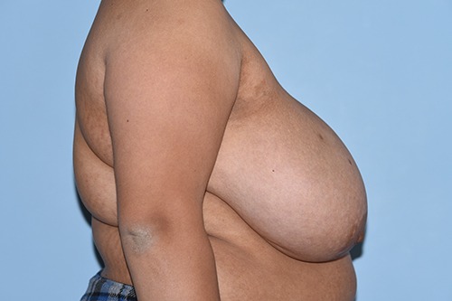 Breast Reduction ( Reduction Mammoplasty)