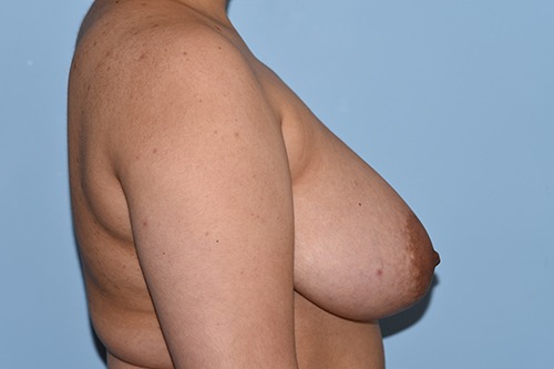 Breast Reduction ( Reduction Mammoplasty)