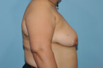 Breast Reduction ( Reduction Mammoplasty)