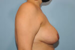 Breast Reduction ( Reduction Mammoplasty)