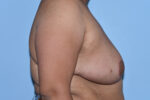 Breast Reduction ( Reduction Mammoplasty)