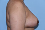 Breast Reduction ( Reduction Mammoplasty)