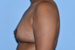 Breast Reduction (Reduction Mammoplasty)