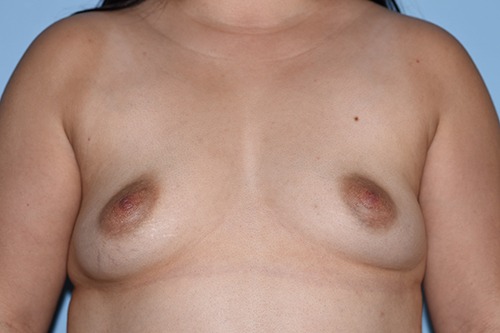 Saline Breast Augmentation (Augmentation Mammoplasty)