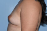 Saline Breast Augmentation (Augmentation Mammoplasty)