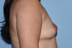 Saline Breast Augmentation (Augmentation Mammoplasty)