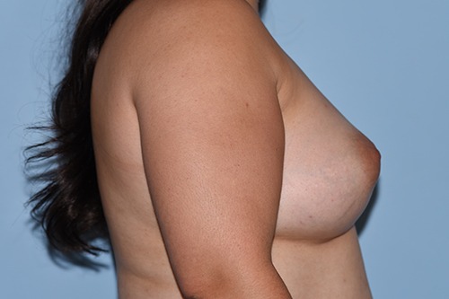 Saline Breast Augmentation (Augmentation Mammoplasty)