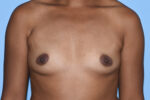 Silicone Breast Augmentation (Augmentation Mammoplasty)