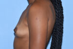 Silicone Breast Augmentation (Augmentation Mammoplasty)