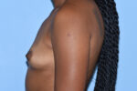 Silicone Breast Augmentation (Augmentation Mammoplasty)