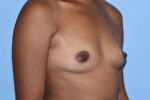 Silicone Breast Augmentation (Augmentation Mammoplasty)