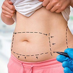 Plastic surgery doctor draw lines with marker on patient's belly