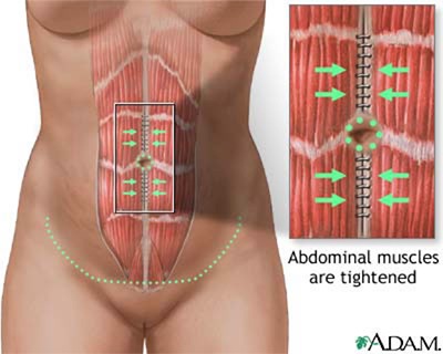 graphic-tummytuck2